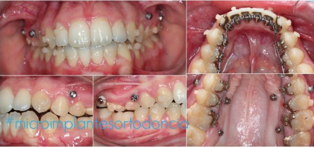 Microimplantes En Ortodoncia Pdf