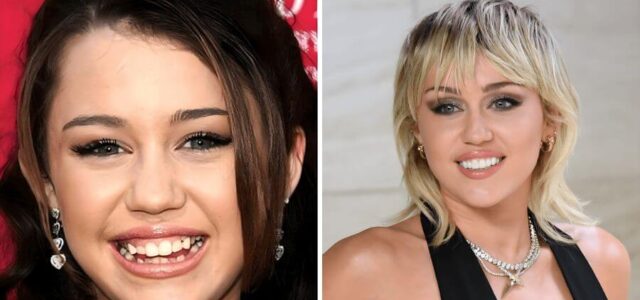 Miley Cyrus con carillas dentales