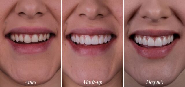 Paciente antes del diseño de sonrisa y después del mockup