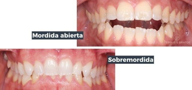 Tipos de mordidas incorrectas en fotos
