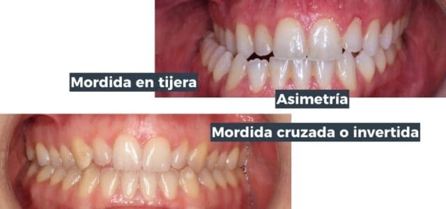 problemas al morder