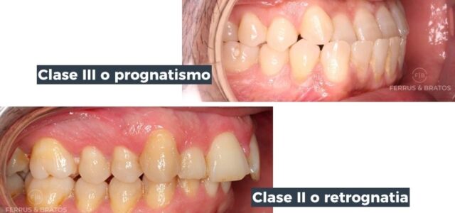 Maloclusiones dentales