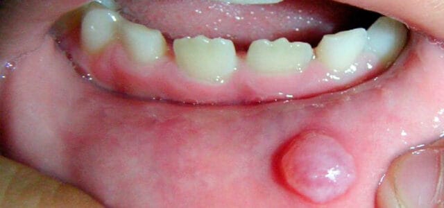 Mucocele en el labio