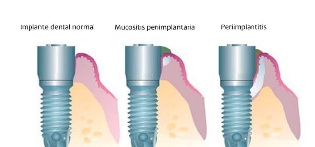 Mucosistis periimplantaria