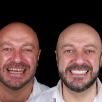 La opinion de carillas dentales de un paciente