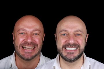 La opinion de carillas dentales de un paciente