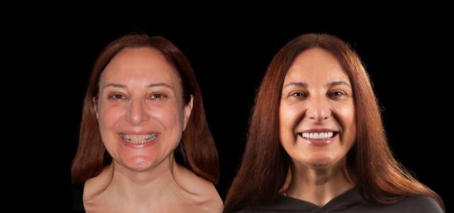 Foto de paciente antes y después y su opinión de carillas dentales
