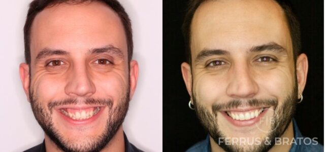Opiniones reales Invisalign