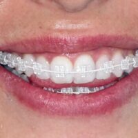 Enfermedad periodontal y brackets