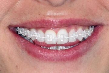 Enfermedad periodontal y brackets