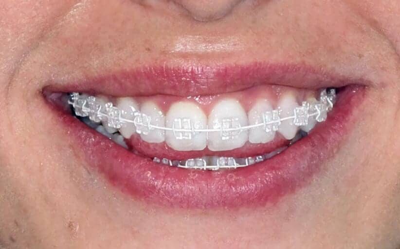 Enfermedad periodontal y brackets