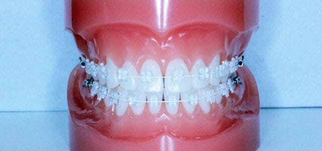 Precio de brackets transparentes