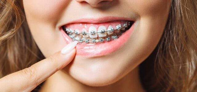 Gomas de brackets ¿Para qué sirven en ortodoncia?