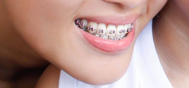 Ortodoncia con brackets Tratamiento combinado: ortodoncia y cirugía ortognática