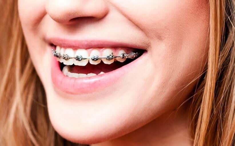 Sonrisa con ortodoncia
