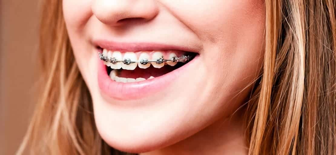 hogar Prefacio simultáneo Cómo cambian mi sonrisa y labios con la Ortodoncia? | Ferrus&Bratos
