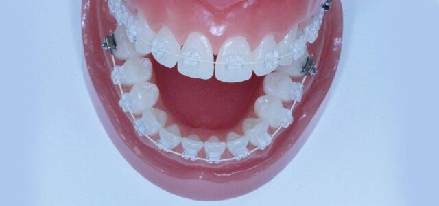 Brackets de porcelana Ortodoncia transparente