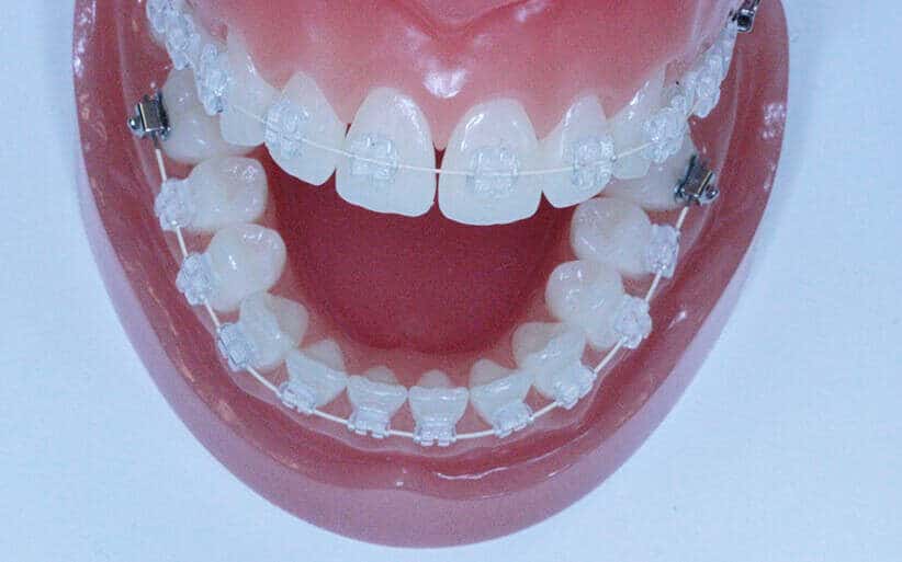 Ortodoncia transparente