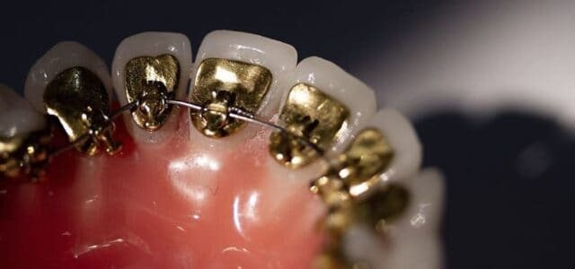 Brackets por dentro de los dientes