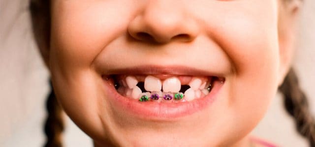 Brackets en niños