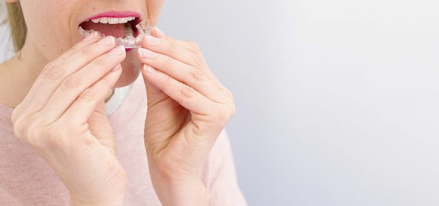 Alineadores Invisalign no duelen Invisalign no es doloroso