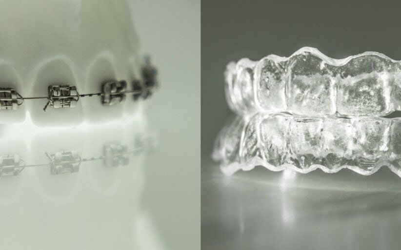 Conoce tu mejor opción entre ortodoncia invisible y brackets ortodoncia invisible o brackets metálicos