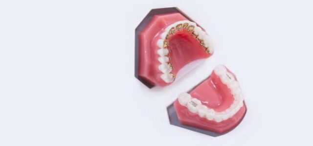 Tipos de ortodoncia invisible Incognito e Invisalign
