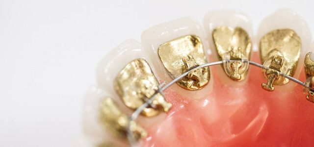 Brackets linguales Ortodoncia lingual Icongito