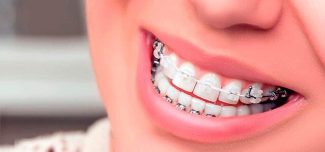 Ortodoncia mixta Brackets combinados