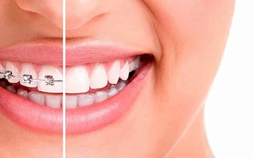 Carillas Dentales: todo lo que debes saber para mejorar el aspecto de tu  sonrisa 