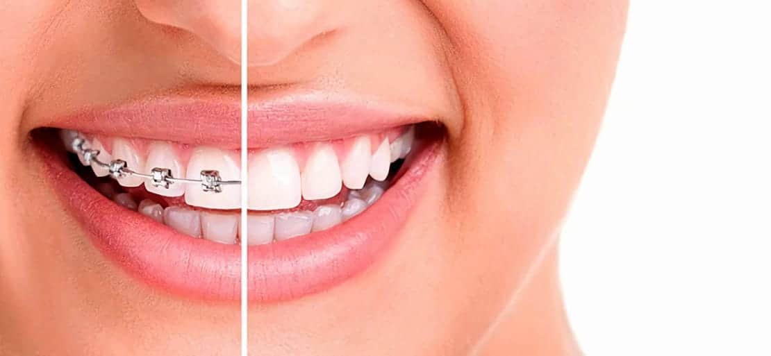 Carillas o Brackets: Cuáles son corregir tus
