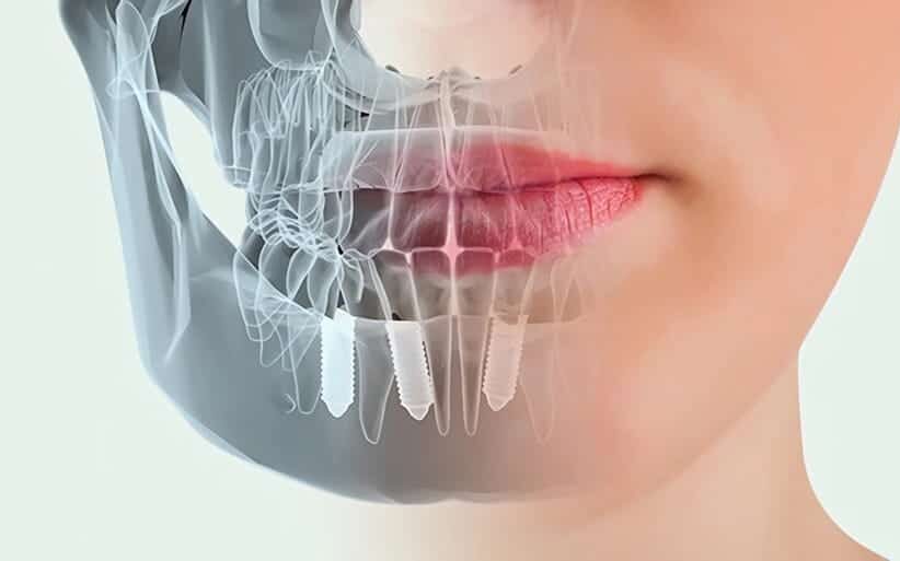 Implantes y osteointegración