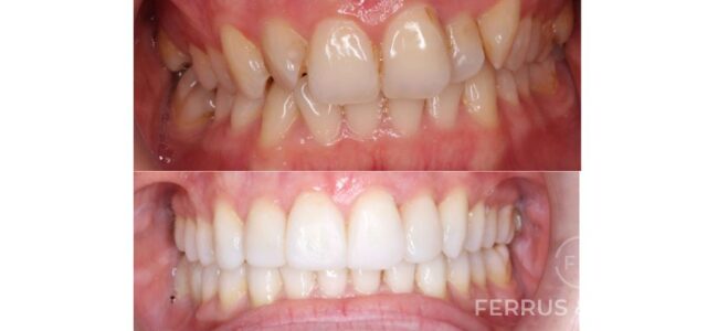 Fotos de antes y despues de piorrea