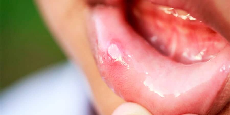 Por garganta ulceras la infeccion en