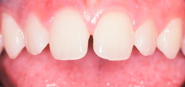 Dientes incisivos con diastema