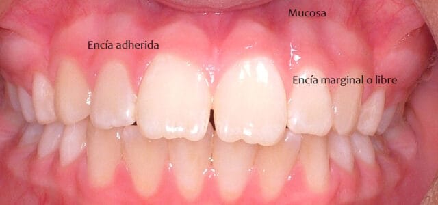 Tipos de encía