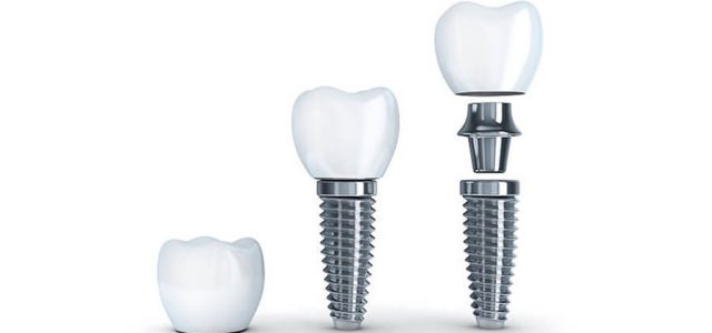 Corona dental sobre implantes