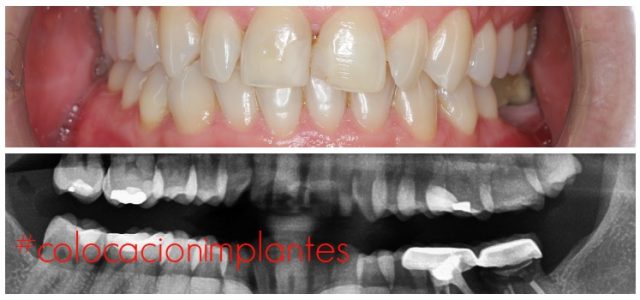 pasos colocar implantes colocacion de implantes dentales paso a paso