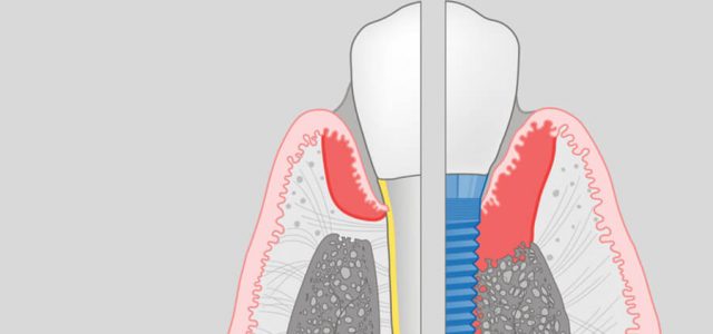 Avance de enfermedad periimplantal