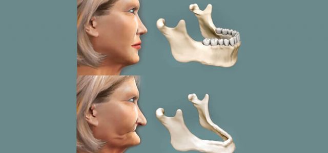 La falta de dientes provoca la reabsorción ósea
