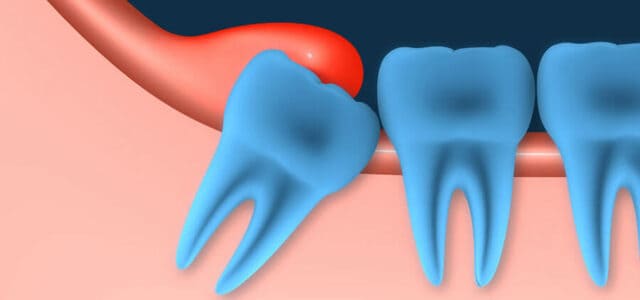 Pericoronaritis muela del juicio