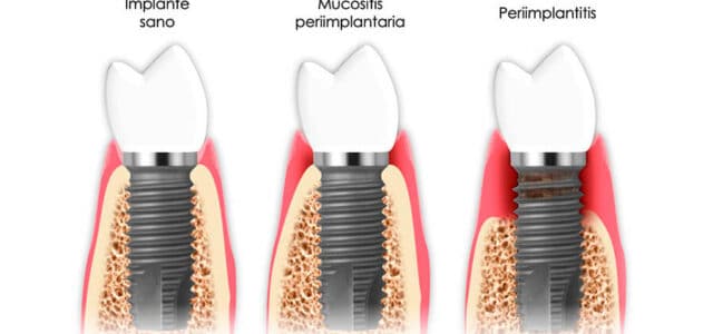 Enfermedades periimplantarias