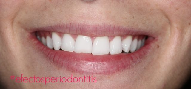periodontitis efectos efectos tratamiento periodontal