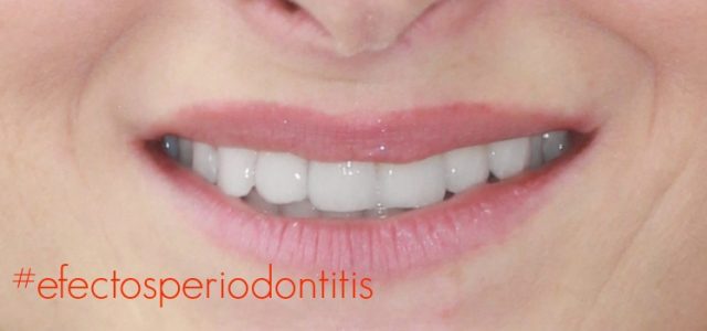 periodontitis efectos secundarios efectos de la periodontitis en la pulpa dental