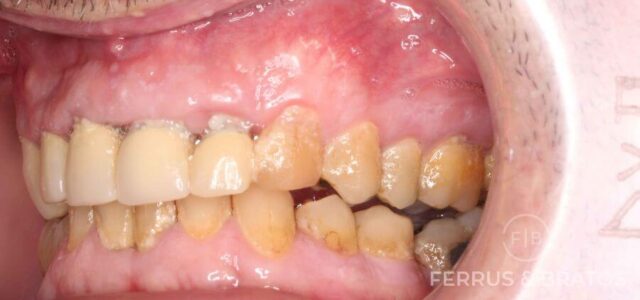 Periodontitis inicial