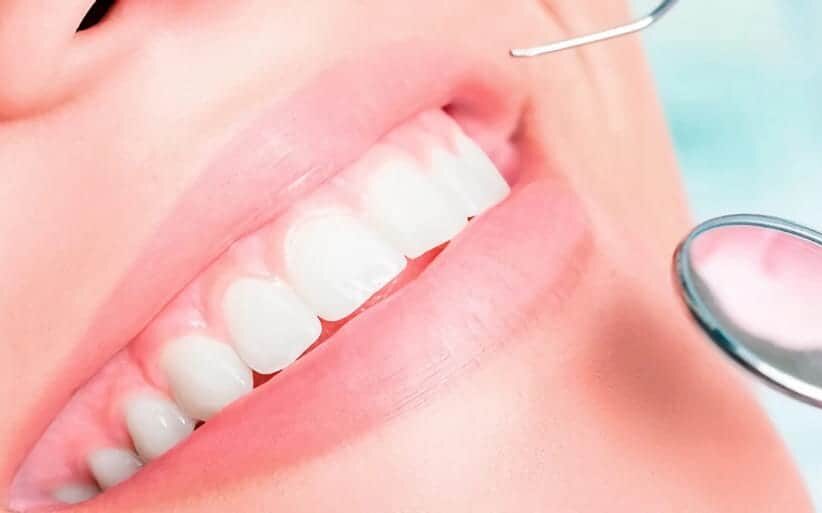 Placa dental Placa bacteriana
