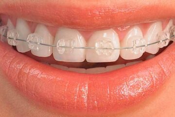Boca con brackets blancos
