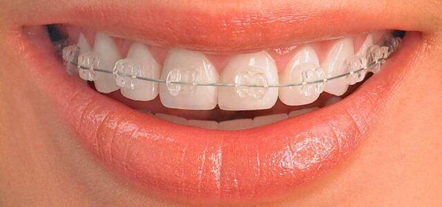 Precio brackets de zafiro Boca con brackets blancos