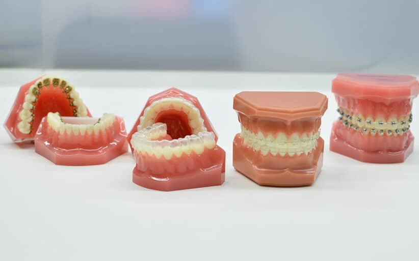 Cuánto cuestan los brackets Precio brackets Madrid