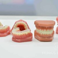 Precio de los brackets en Madrid